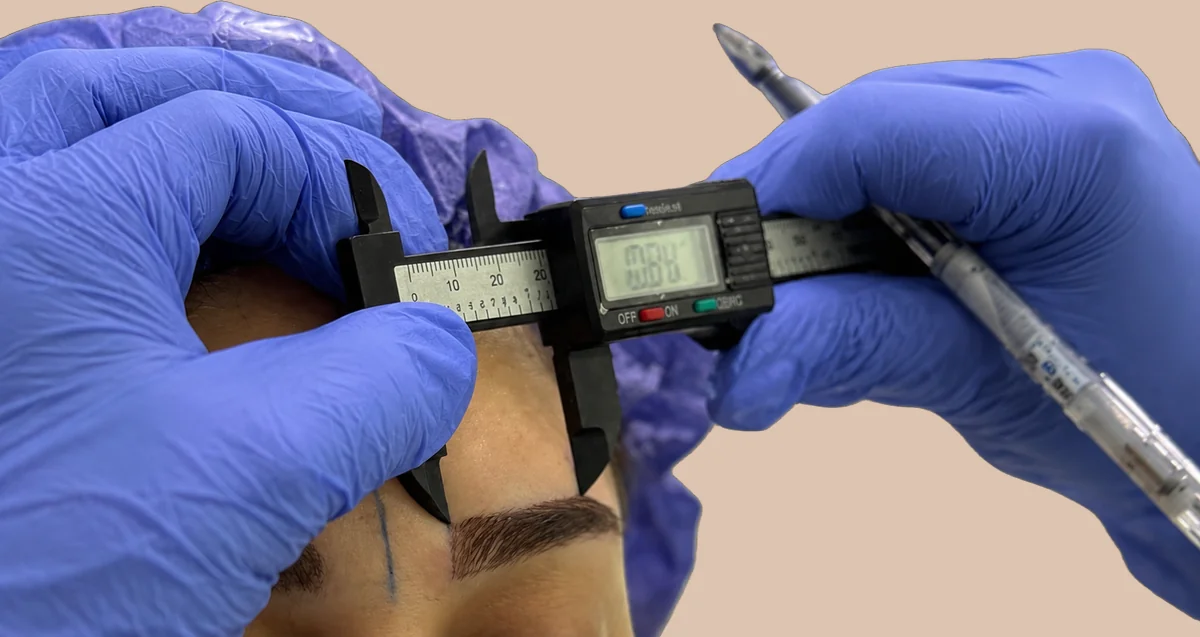 Brow architecture being measured during the design phase with digital calipers and a surgical marker