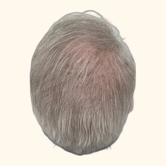 After hair transplant