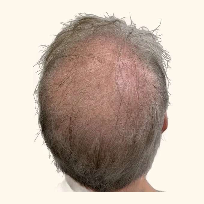 Before hair transplant