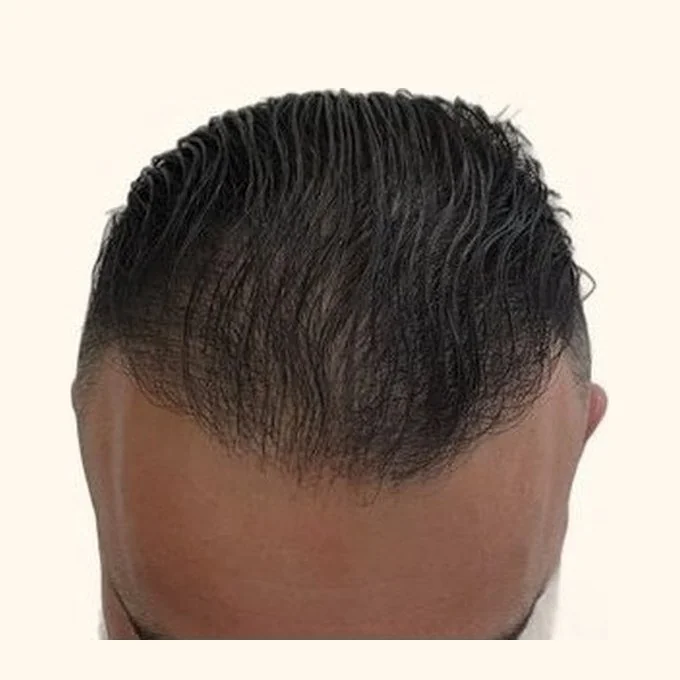 After hair transplant