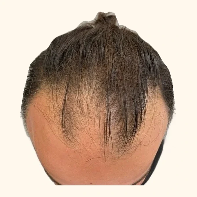 Before hair transplant