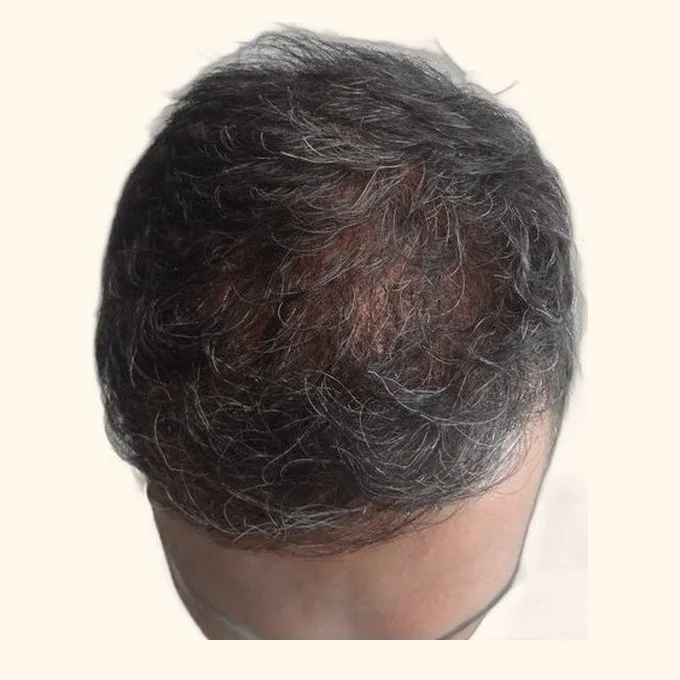 After hair transplant — full restoration