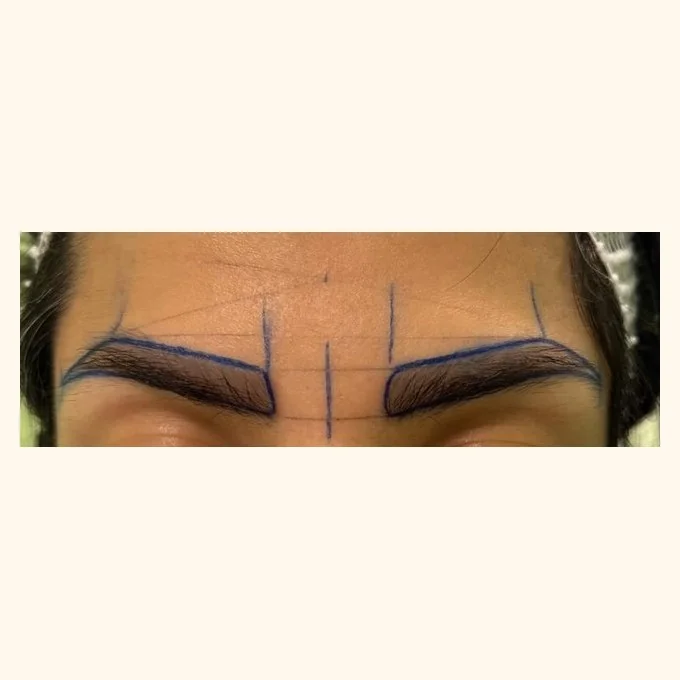 Before eyebrow transplant — brow restoration