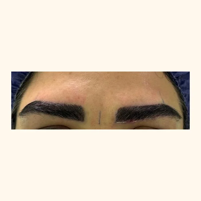 After eyebrow restoration