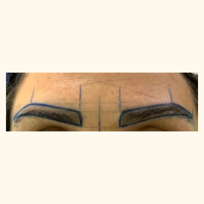 Before eyebrow restoration