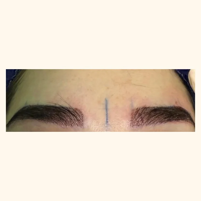 After eyebrow transplant — brow restoration