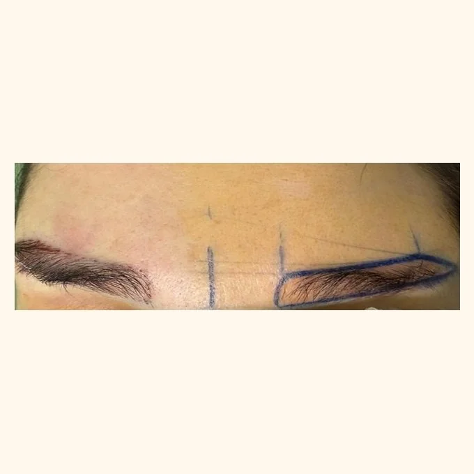 Before eyebrow transplant — brow restoration