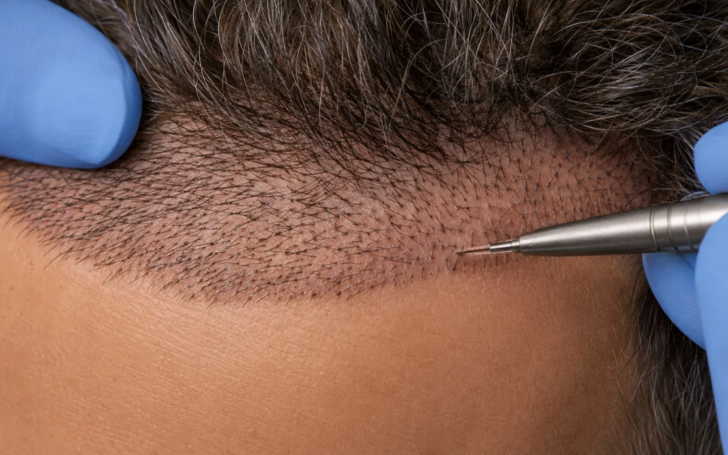 FUE hair transplantation detail